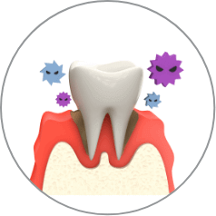 歯周病の診断